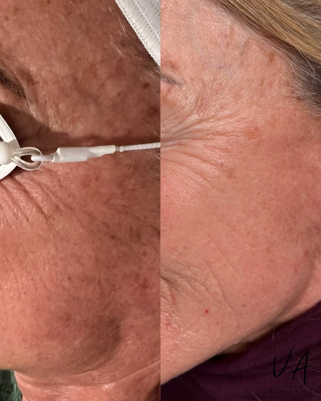 Swipe to see what consistency + the right treatment plan can do ✨
This beautiful improvement is the result of 3 IPL sessions, 1 Perfect Derma Peel, and a curated, results-driven skincare regimen designed specifically for her skin.

What you&rsquo;re 