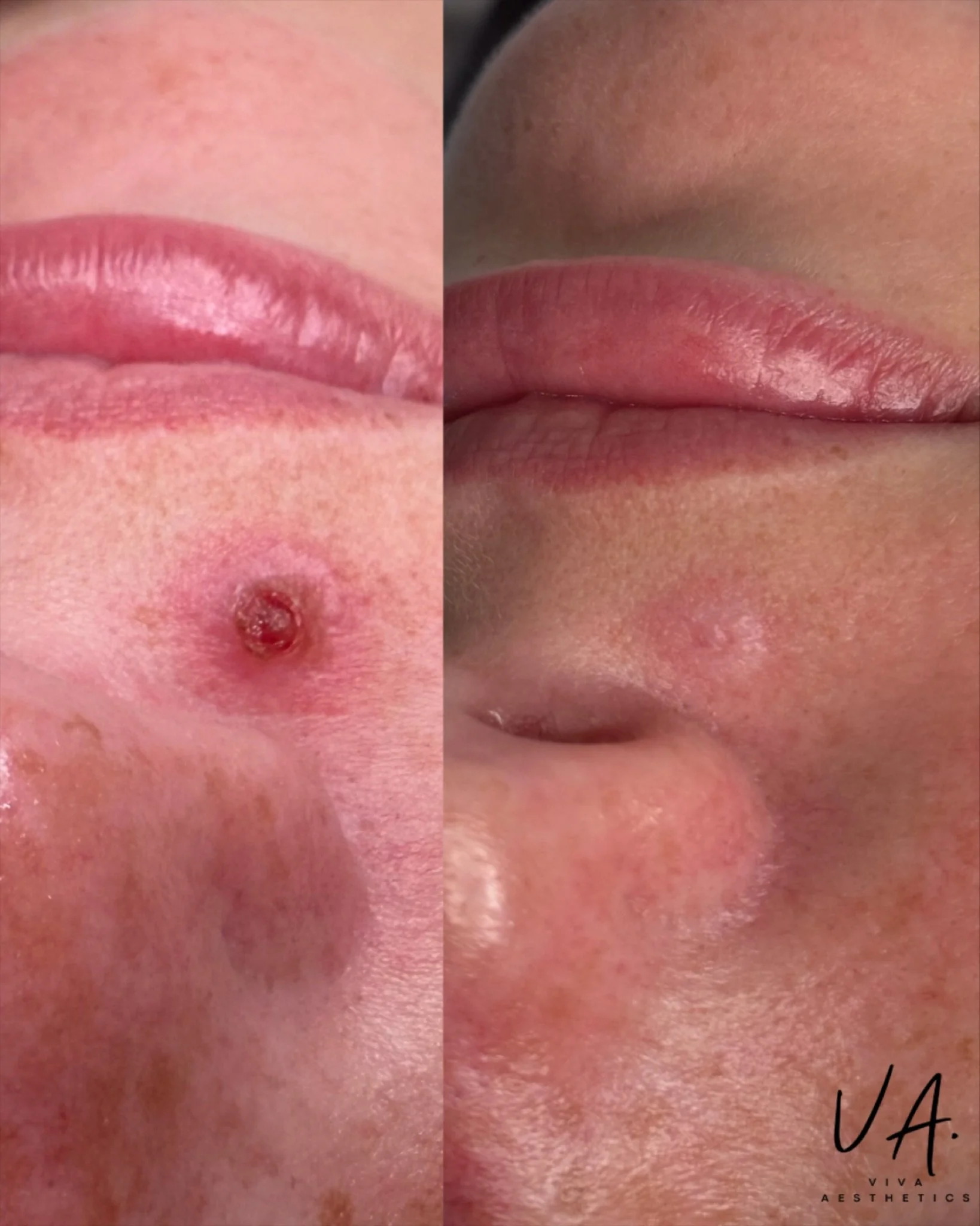 This beautiful client of mine developed pyogenic granuloma also known as a lobular capillary hemangioma ( very common benign vascular lesion ) while pregnant. 
After consulting with her I had her get it checked by her doctor and cleared for laser, we
