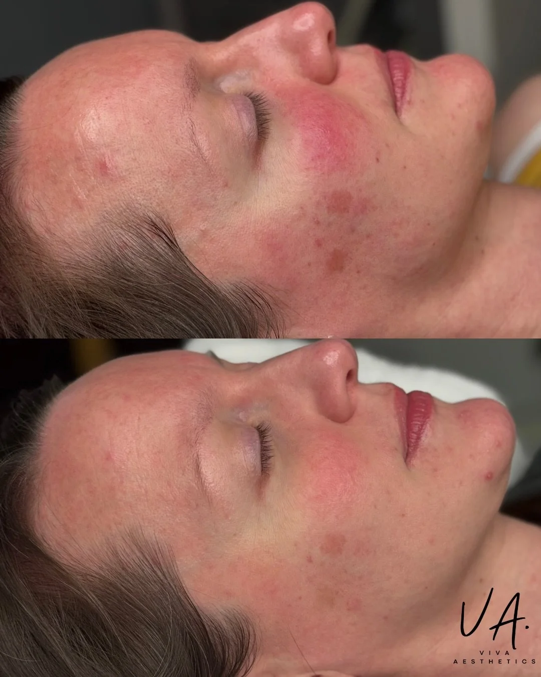 ✨Just 1 IPL&mdash;&mdash;The before photo was taken 10 days ago and the after today, there is a significant reduction in redness and lightening of the pigmented lesions.  This is only the beginning we are doing a series of three because the best resu
