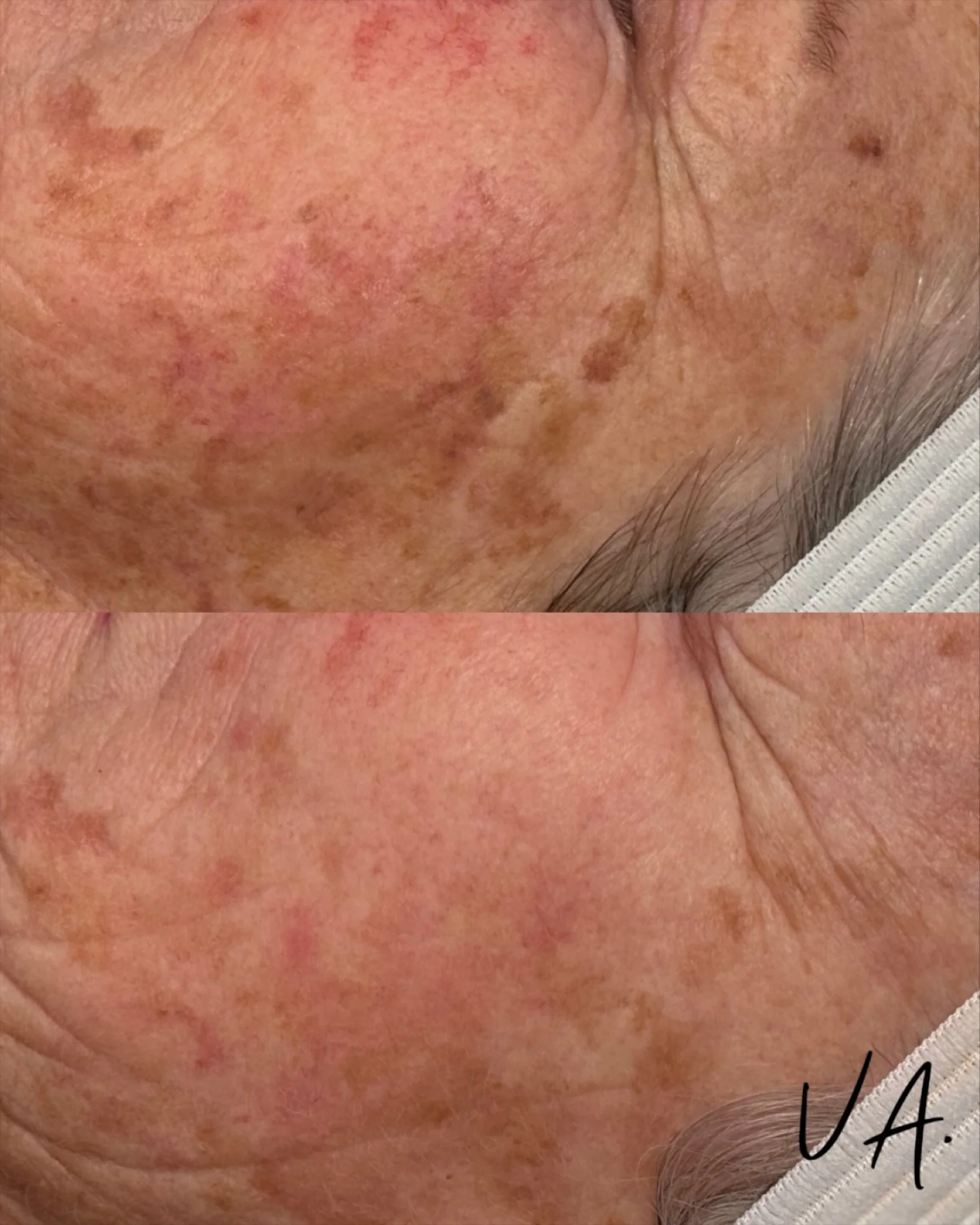 Progressive not aggressive 🫶🏻 

These results are after one IPL photofacial , this client purchased a PKG of 3 and we are doing treatments every 6 weeks for cumulative results ✨

📲 360.909.1619
👩&zwj;💻 vivaaestheticsridgefield.com
📍 411 N Main 