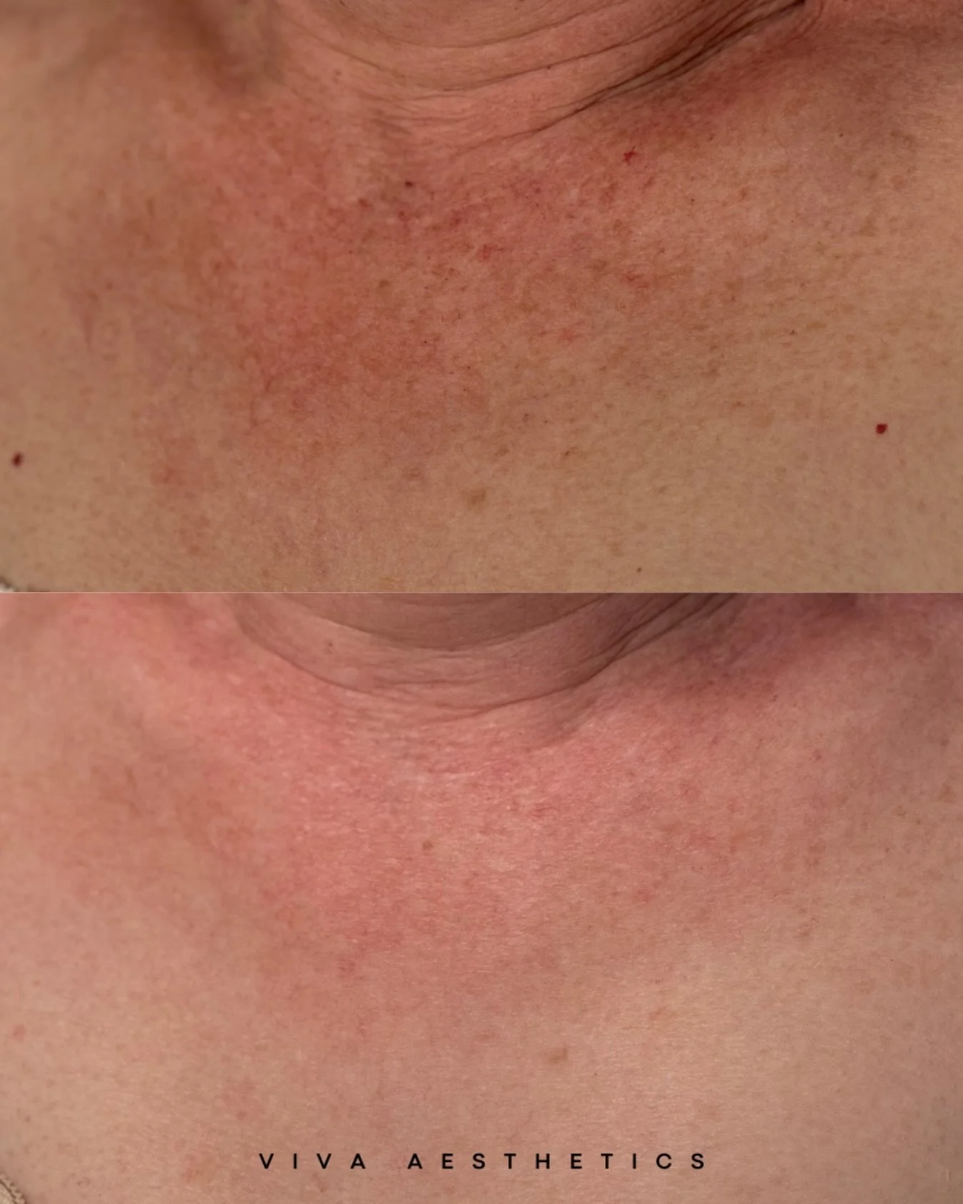 This is the results of a IPL + YAG treatment ✨

Important to protect your neck &amp; dec friends but if it&rsquo;s too late for that &hellip;. There are options!

📲 360.909.1619
👩&zwj;💻 vivaaestheticsridgefield.com
📍 411 N Main Ave Ridgefield WA 