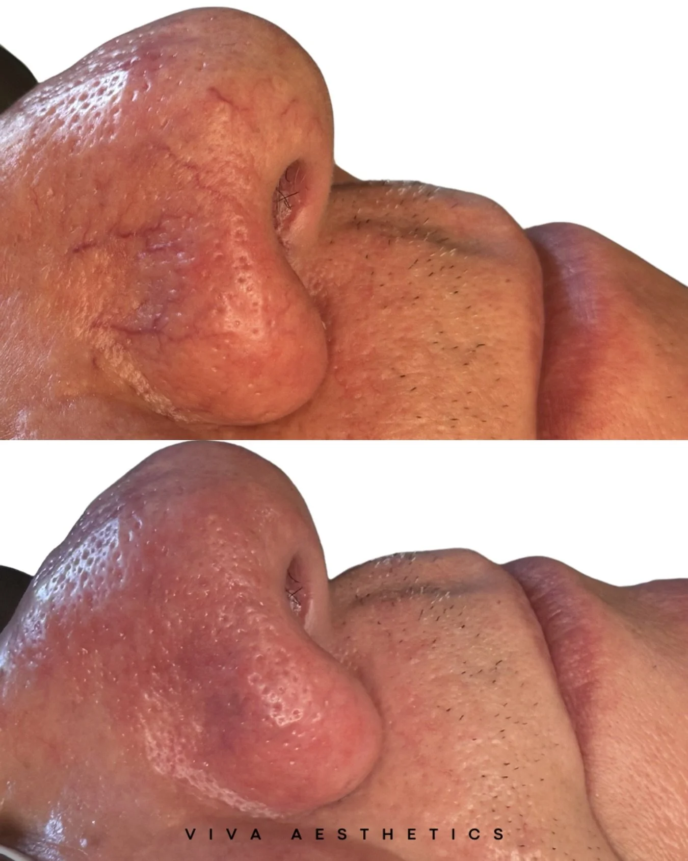 🤍 2 Things.
1. I love all of the veins, telangectasias &amp; cherry angiomas I&rsquo;ve been treating lately 🫶🏻
2. I love that I have been seeing soooo many more men on my table 🫶🏻

Need a spring refresh ?? We got you 🩷

📲 360.909.1619
👩&zwj;