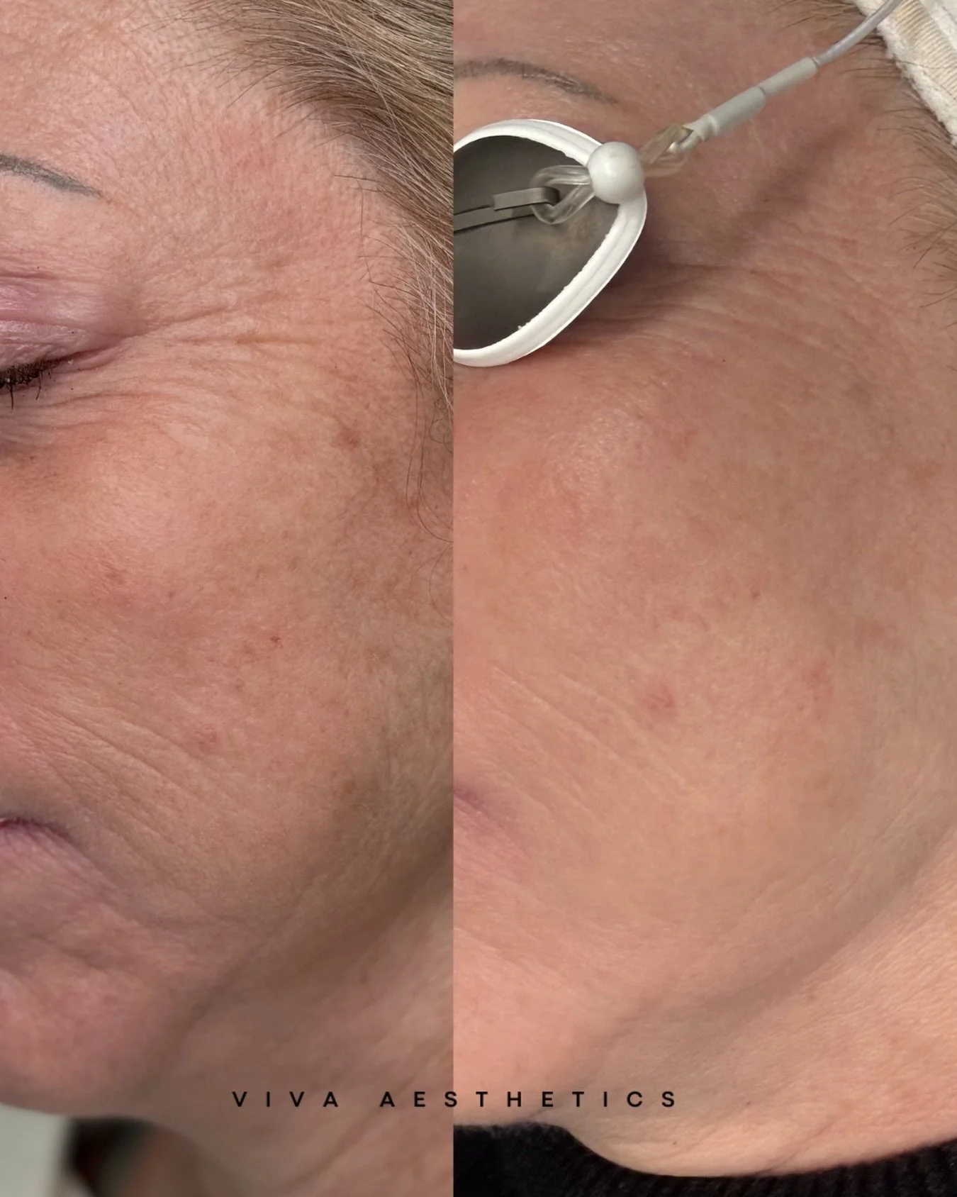 Subtle, but significant. ✨
IPL works beneath the surface to even tone, soften fine lines, and restore a more balanced complexion&mdash;no filters needed.

📲 360.909.1619
👩&zwj;💻 vivaaestheticsridgefield.com
📍 411 N Main Ave Ridgefield WA 98642

?