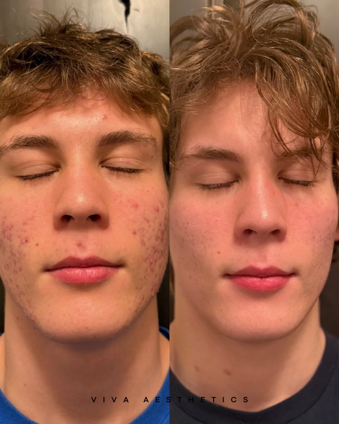 I did that 🥹 &hellip; Just a targeted skincare regimen , no treatments.

First picture was taken November 1st  and most recent picture March 21st.

All of the active / inflamed acne is gone , what&rsquo;s remaining is post inflammatory hyperpigmenta