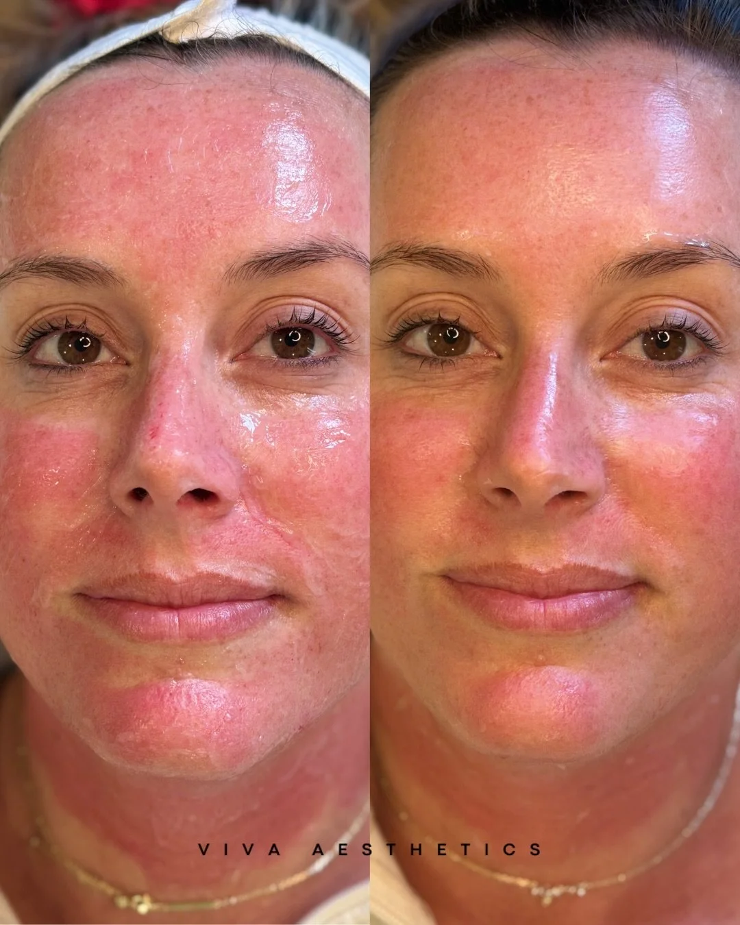 ✨ SkinPen + CO2Lift Pro = the ultimate recovery and glow duo ✨

Look at the difference in redness immediately after treatment! 👏

For this treatment, we paired SkinPen microneedling with the CO2Lift Pro Carboxy Gel to help calm inflammation, support