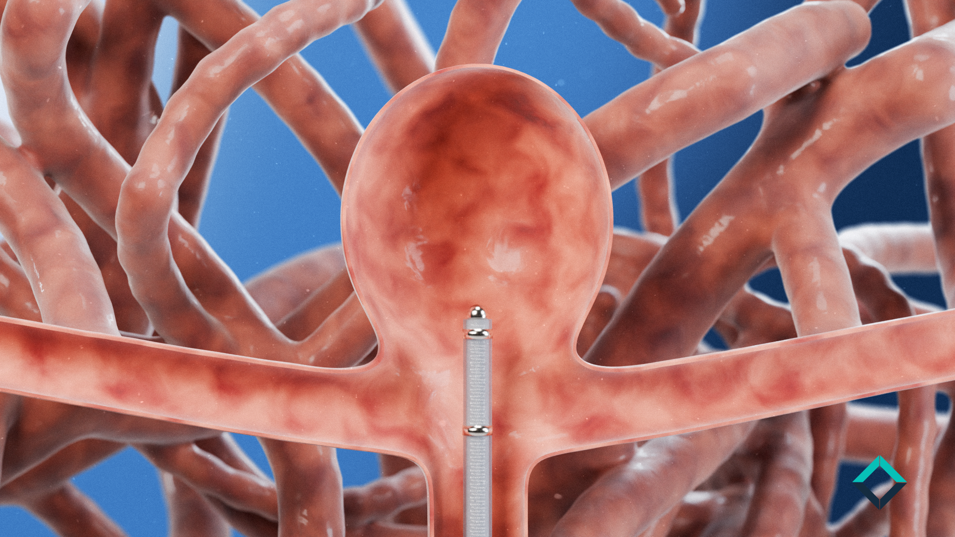 Catheter entering the sac