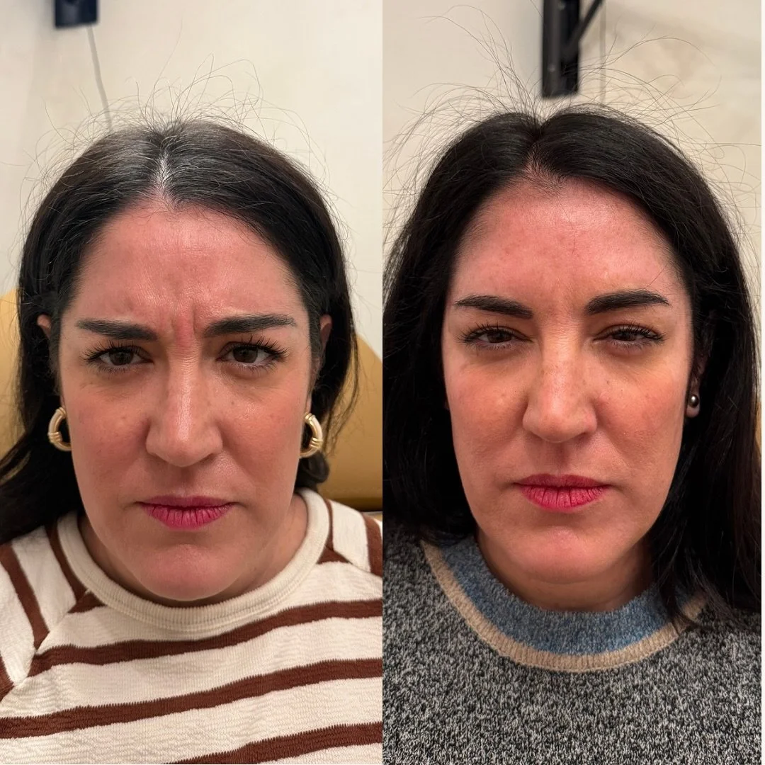 𝐀 𝐬𝐮𝐛𝐭𝐥𝐞 𝐬𝐡𝐢𝐟𝐭 𝐭𝐡𝐚𝐭 𝐦𝐚𝐤𝐞𝐬 𝐚𝐥𝐥 𝐭𝐡𝐞 𝐝𝐢𝐟𝐟𝐞𝐫𝐞𝐧𝐜𝐞 🤍

We treated her glabella and crow&rsquo;s feet with Dysport - not to freeze, but to soften.

You can see how her brows have gently lifted, opening up her eyes and gi