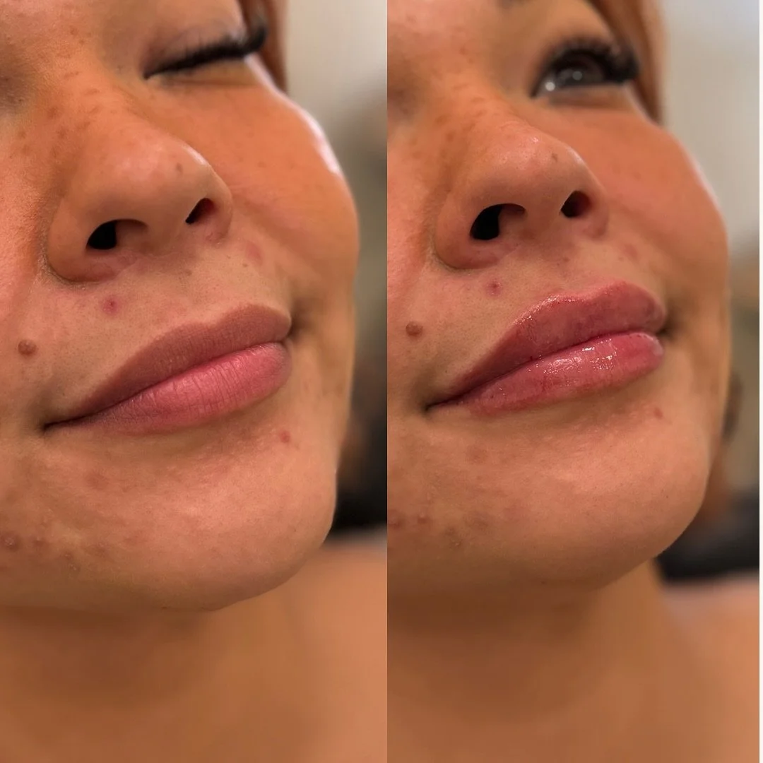 𝐒𝐨𝐟𝐭, 𝐛𝐚𝐥𝐚𝐧𝐜𝐞𝐝, 𝐚𝐧𝐝 𝐬𝐮𝐛𝐭𝐥𝐲 𝐞𝐧𝐡𝐚𝐧𝐜𝐞𝐝.

Just the right touch of hydration and height to bring harmony to her features. ✨

A reminder that beautiful results don&rsquo;t need to be dramatic to be transformative.

#mnmedspa #m