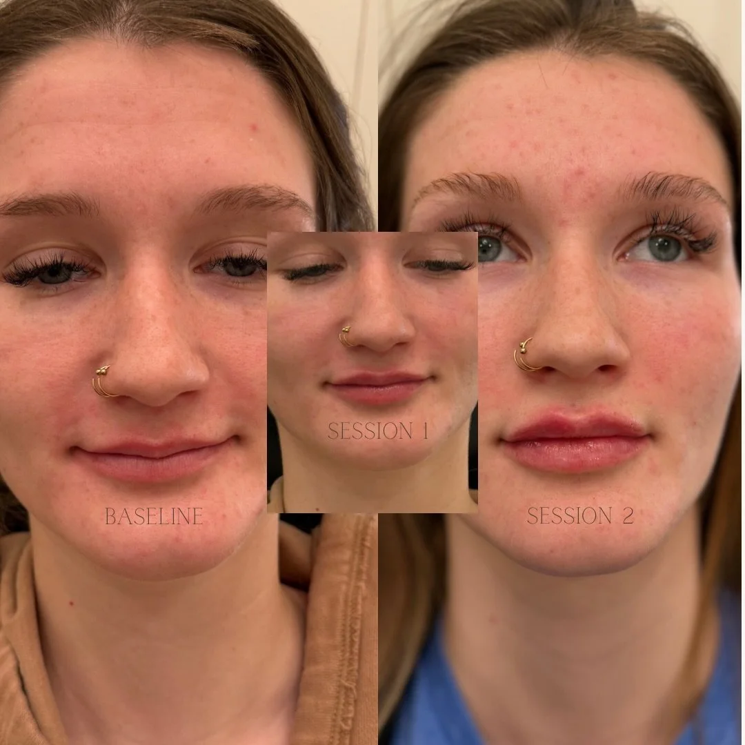 𝐋𝐢𝐩 𝐟𝐢𝐥𝐥𝐞𝐫 𝐢𝐬𝐧&rsquo;𝐭 𝐚𝐥𝐰𝐚𝐲𝐬 𝐚 𝐨𝐧𝐞-𝐚𝐧𝐝-𝐝𝐨𝐧𝐞 𝐦𝐨𝐦𝐞𝐧𝐭. 𝐒𝐨𝐦𝐞𝐭𝐢𝐦𝐞𝐬, 𝐢𝐭&rsquo;𝐬 𝐚 𝐩𝐫𝐨𝐜𝐞𝐬𝐬. 🤎

These lips started with an M-shape that we opted to gently correct and balance. 𝐓𝐰𝐨 𝐬𝐞𝐬𝐬𝐢𝐨𝐧𝐬.