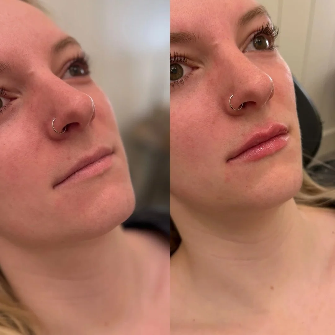 𝐇𝐲𝐝𝐫𝐚𝐭𝐞𝐝, 𝐛𝐚𝐥𝐚𝐧𝐜𝐞𝐝, 𝐚𝐧𝐝 𝐟𝐞𝐦𝐢𝐧𝐢𝐧𝐞.

We respected her natural lip shape entirely 🤎 Adding only soft support to the cupid&rsquo;s bow and border to enhance what was already there.

This is what &ldquo;𝐥𝐞𝐬𝐬&rdquo; looks li