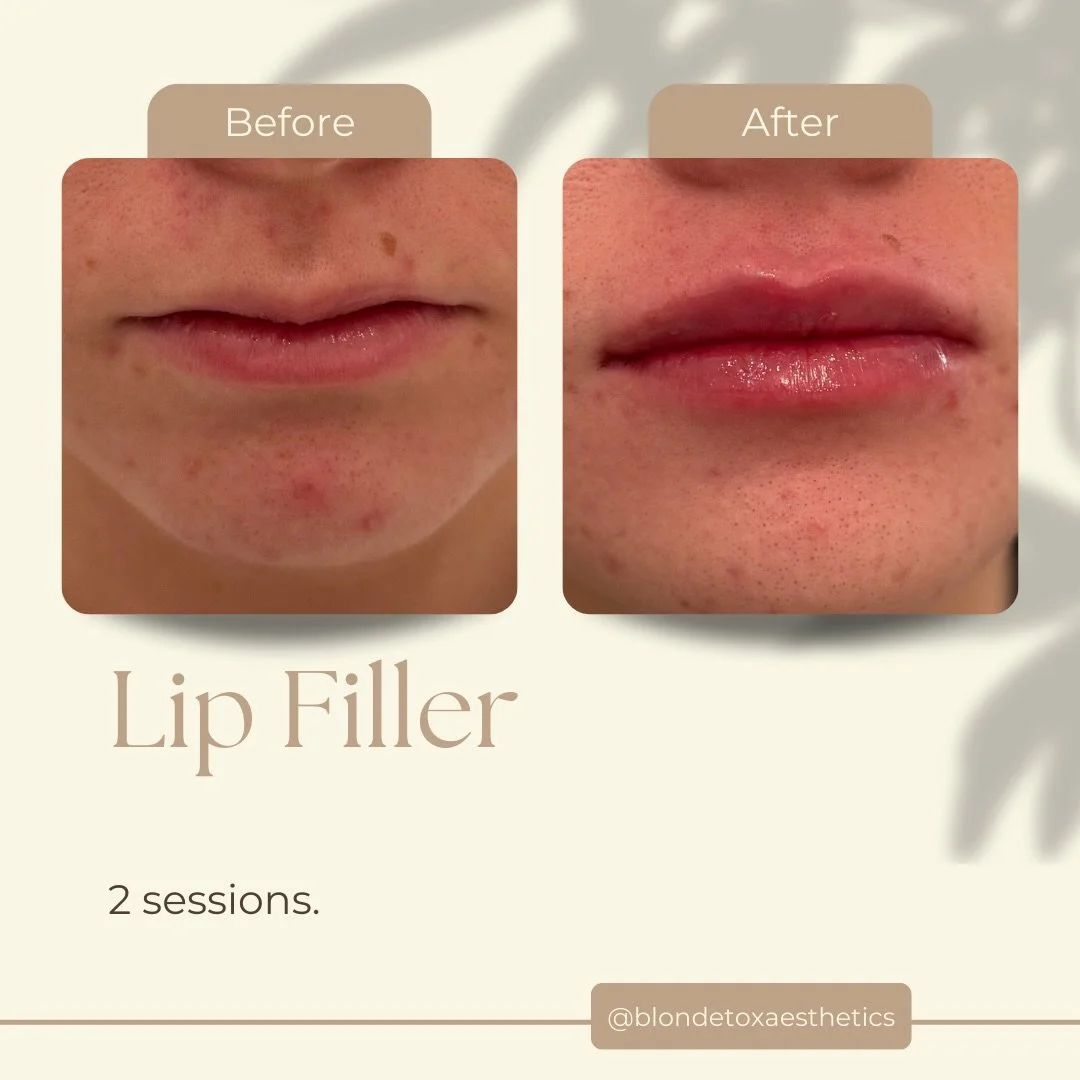 𝐁𝐞𝐚𝐮𝐭𝐢𝐟𝐮𝐥 𝐥𝐢𝐩𝐬 𝐚𝐫𝐞𝐧&rsquo;𝐭 𝐫𝐮𝐬𝐡𝐞𝐝. 𝐓𝐡𝐞𝐲&rsquo;𝐫𝐞 𝐛𝐮𝐢𝐥𝐭.

This transformation took two intentional sessions to correct an M-shaped lip, gently support upper-lip show, and restore hydration before chasing volume.

Yo