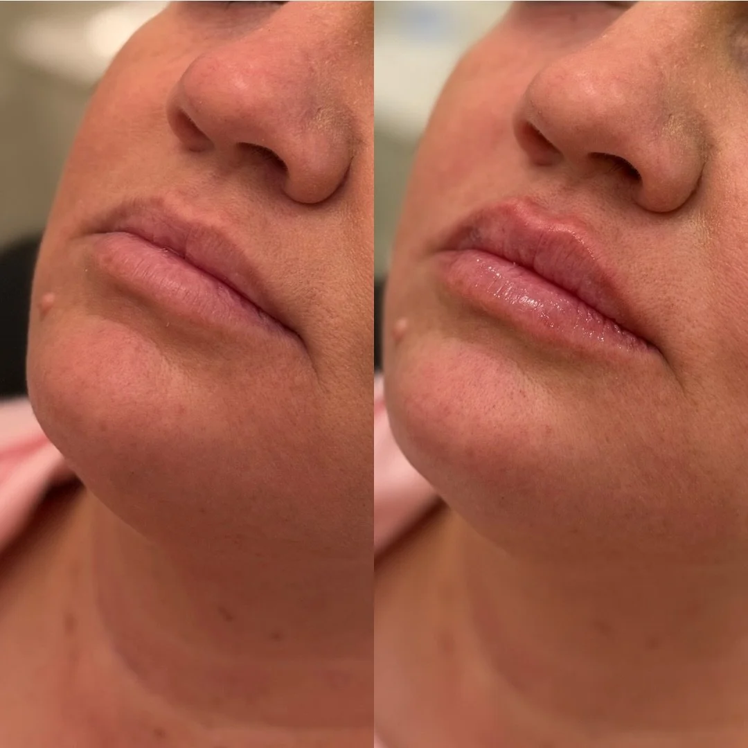 𝐆𝐚𝐥𝐞𝐧𝐭𝐢𝐧𝐞&rsquo;𝐬 𝐩𝐥𝐚𝐧𝐬? 💖
Start with something just for 𝐲𝐨𝐮. 

These results are built with intention - never overfilled.
Subtle structure, restored hydration, and a shape that feels natural and lived-in.

Because sometimes self-l