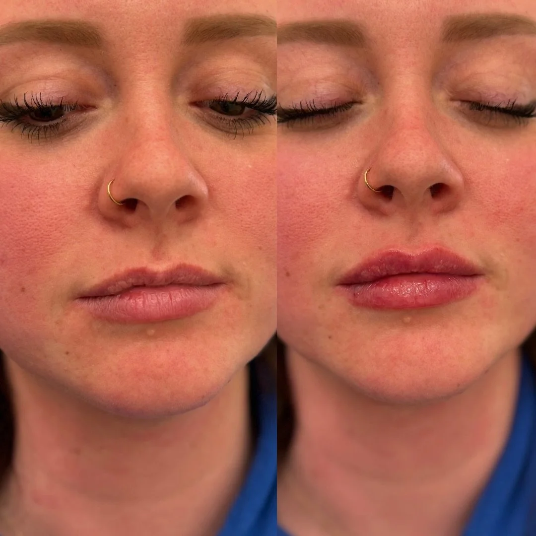 𝐐𝐮𝐢𝐞𝐭 𝐫𝐞𝐟𝐢𝐧𝐞𝐦𝐞𝐧𝐭.
𝐓𝐡𝐚𝐭&rsquo;𝐬 𝐢𝐭. 🤎

#mnmedspa #mnbrides #brainerdlakesarea