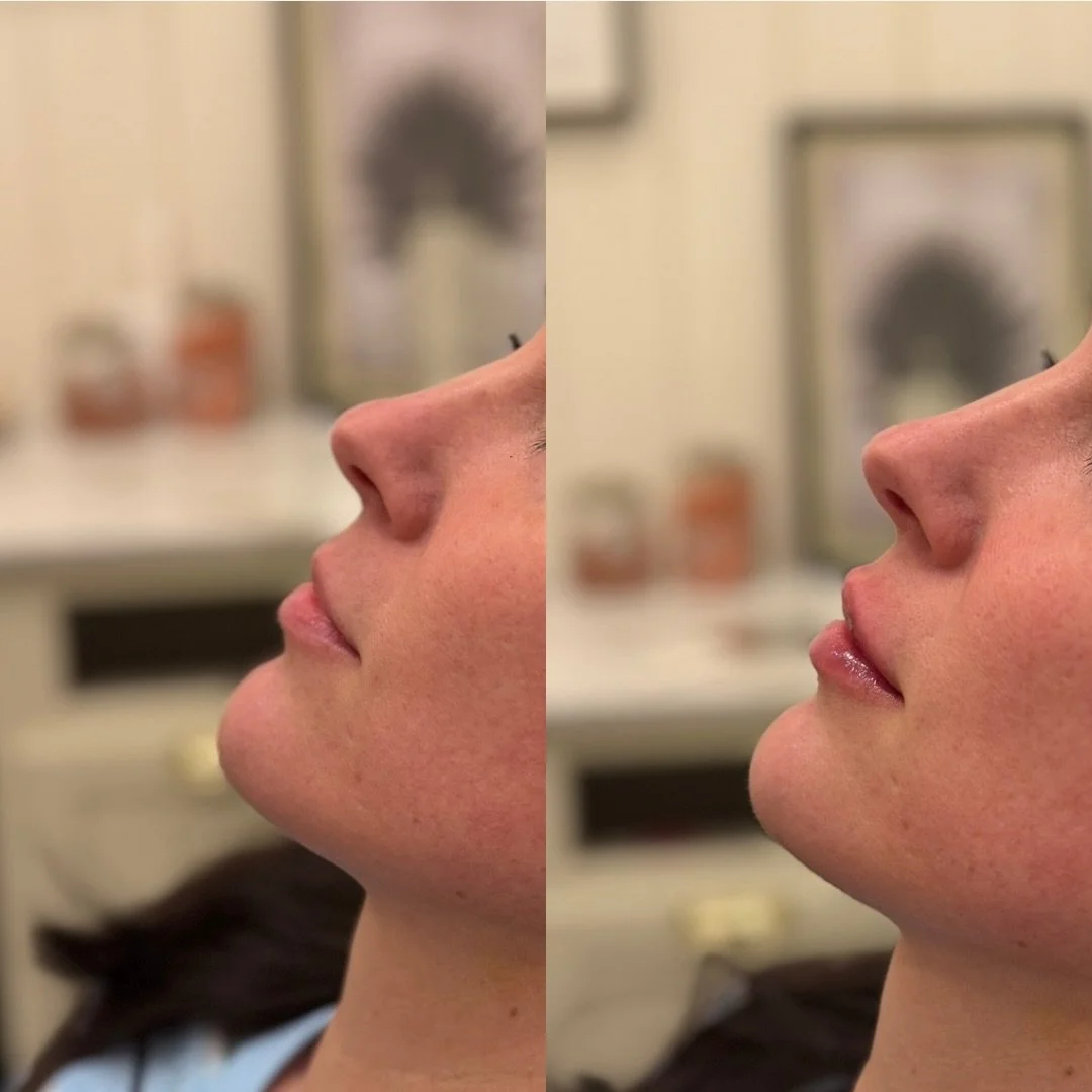 Respecting her natural shape.
Restoring hydration.
Adding subtle height while keeping everything 𝐬𝐨𝐟𝐭 and 𝐟𝐞𝐦𝐢𝐧𝐢𝐧𝐞. 🕊️ 

This is the kind of lip work I love most.
𝐁𝐚𝐥𝐚𝐧𝐜𝐞𝐝 𝐚𝐧𝐝 𝐈𝐧𝐭𝐞𝐧𝐭𝐢𝐨𝐧𝐚𝐥. 

Immediate post-injection
