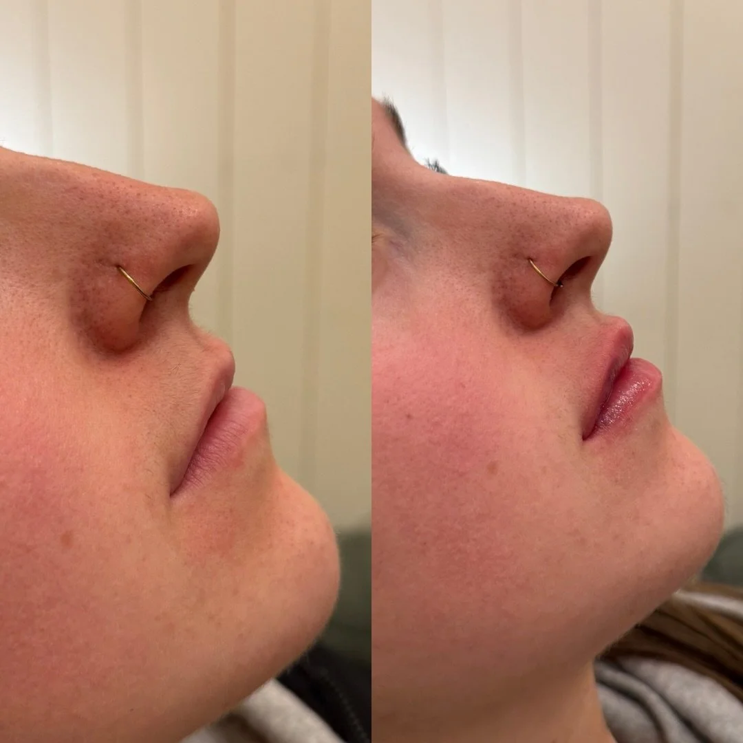 It&rsquo;s not about adding more. It&rsquo;s about placing the right product and amount in the right places.

This transformation used a small amount of filler, placed precisely to support areas where the lip had natural gaps and deficiencies. The go