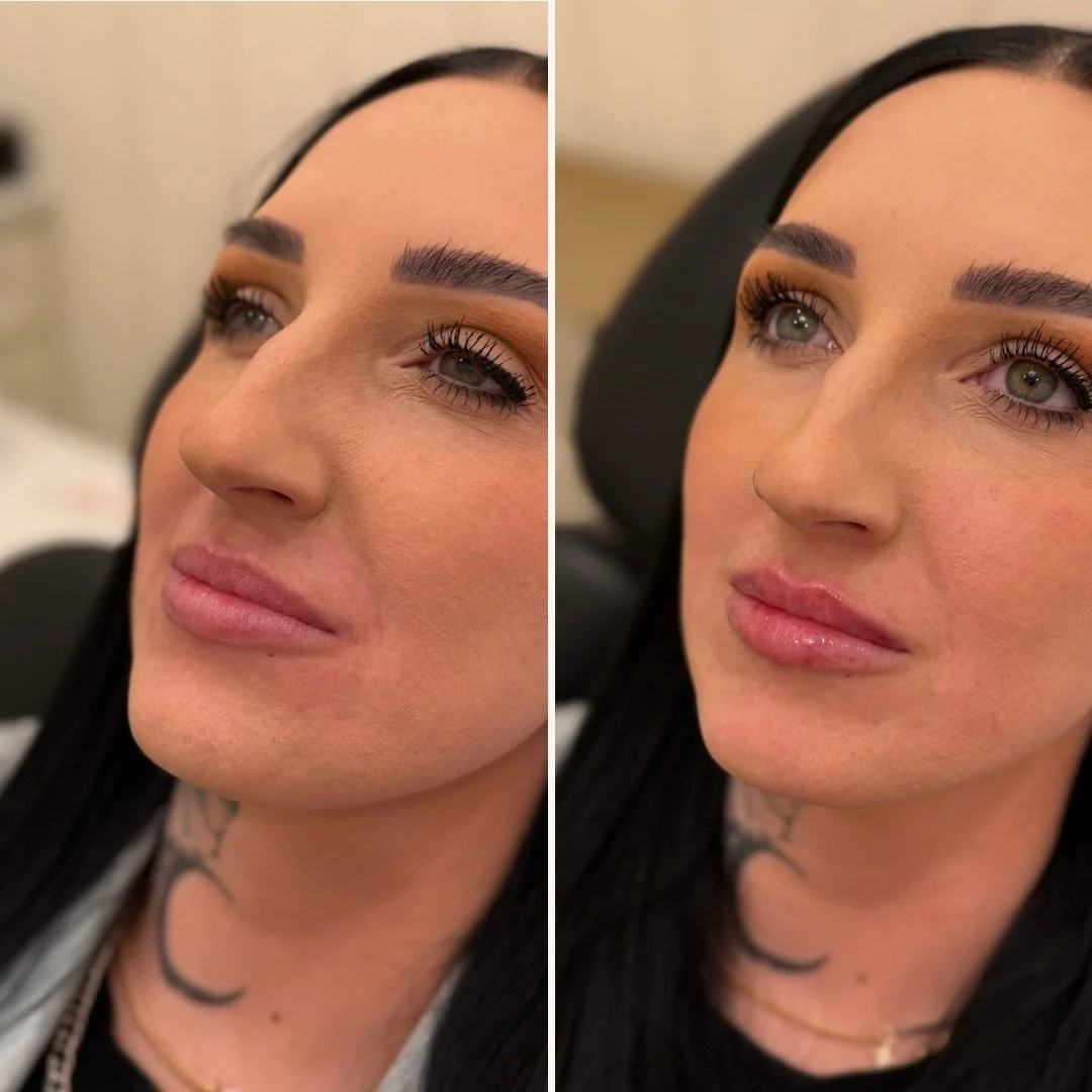 More filler doesn&rsquo;t mean a better result.

The amount I choose is based off a thorough assessment of your anatomy, tissue, previous filler history, and goals. 

I provide results that whisper, not shout.
Refined, not overpowering ✿

#brainerdla