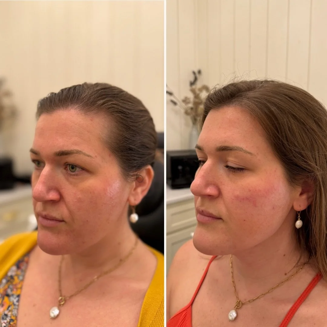 This is one of my favorite examples of how subtle refinements can create beautiful impact. Soft support through the cheeks paired with upper-face Dysport creates a refreshed, rested appearance without looking &ldquo;done.&rdquo;

Refined. Natural. Bu