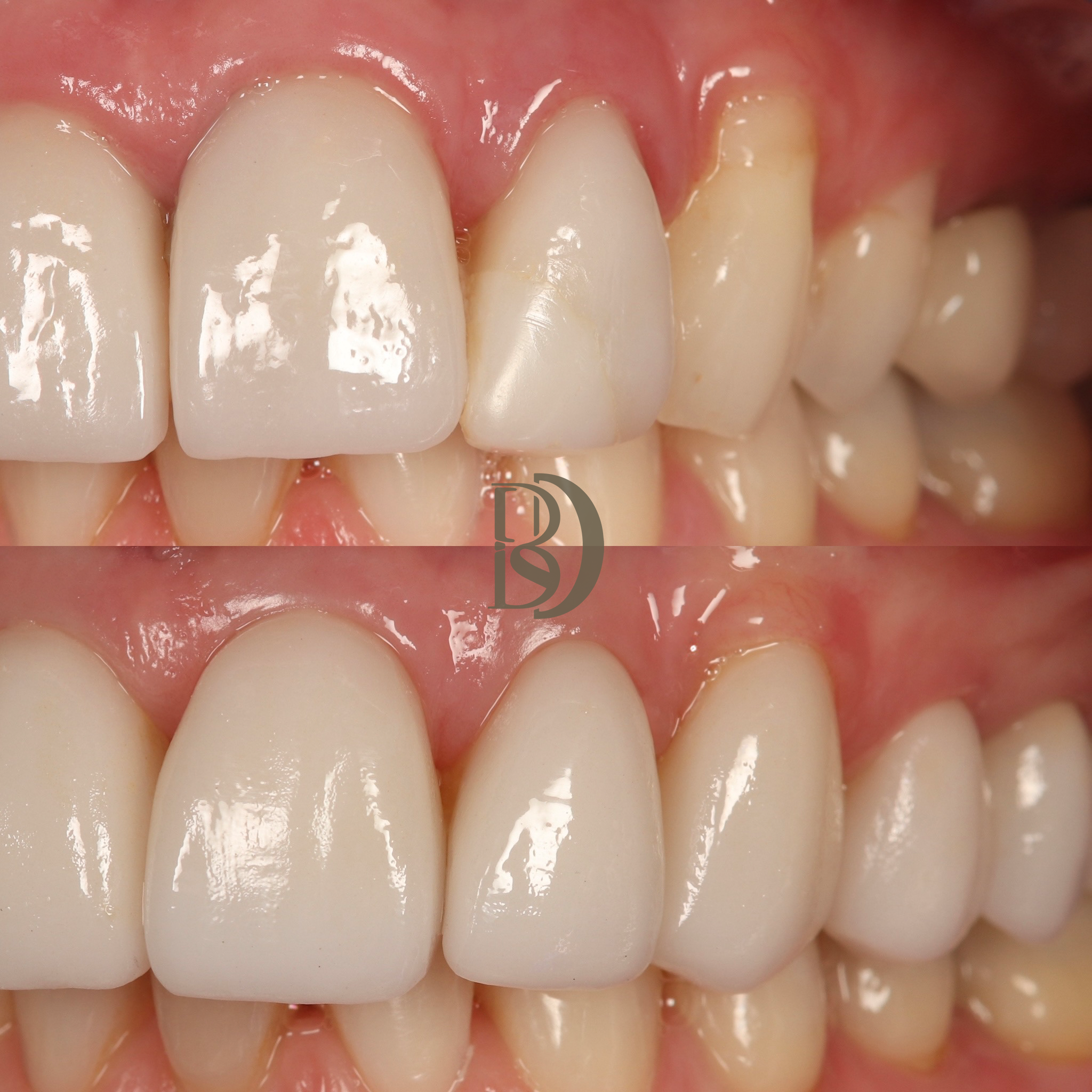 Replacement porcelain veneers_crowns.png