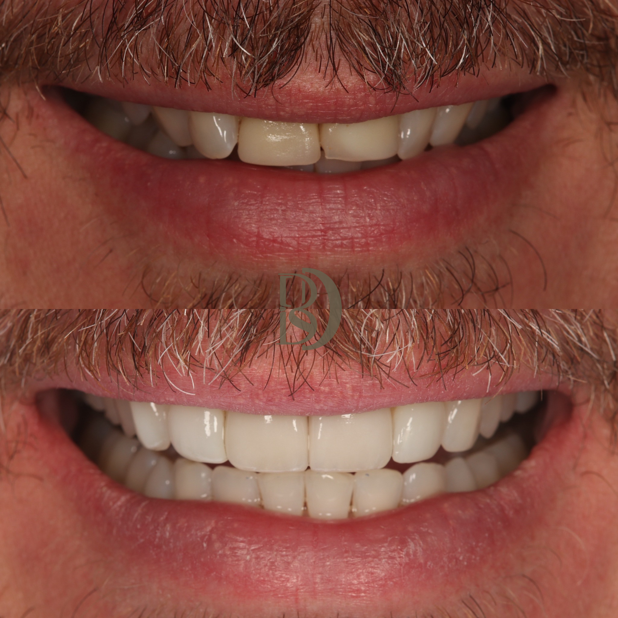 MP align, bleach, veneers, bonding 3.png
