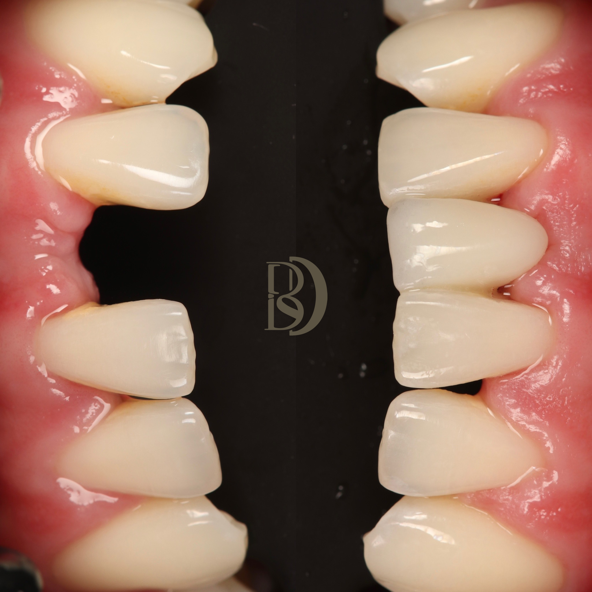 Resin bonded bridge lower following trauma.png