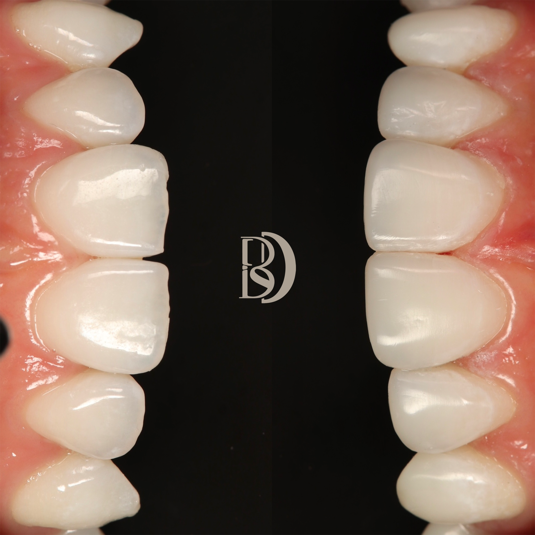 Edge Bonding 4-4 contrast.png