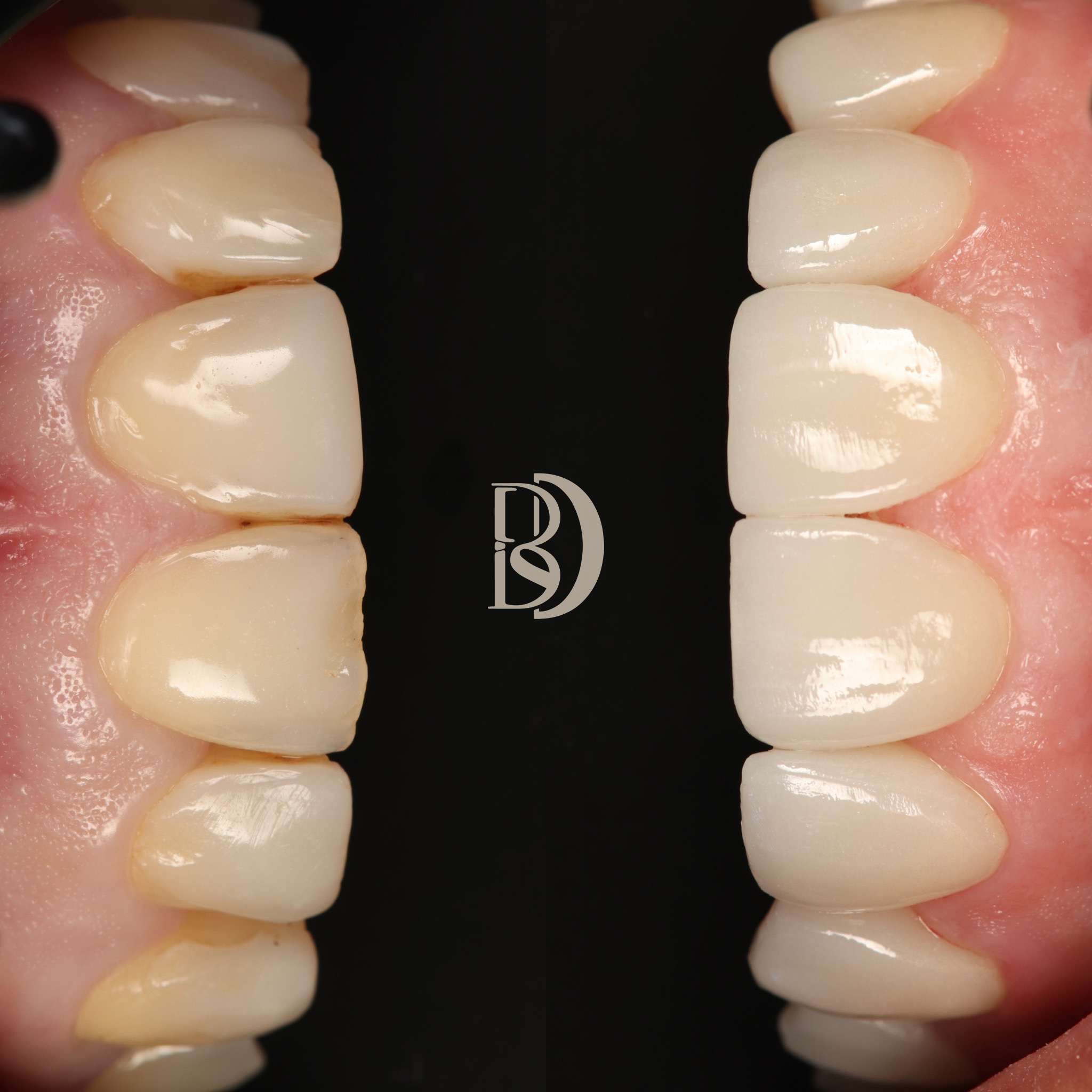 8x porcelain veneers to replace old composite bonding.png