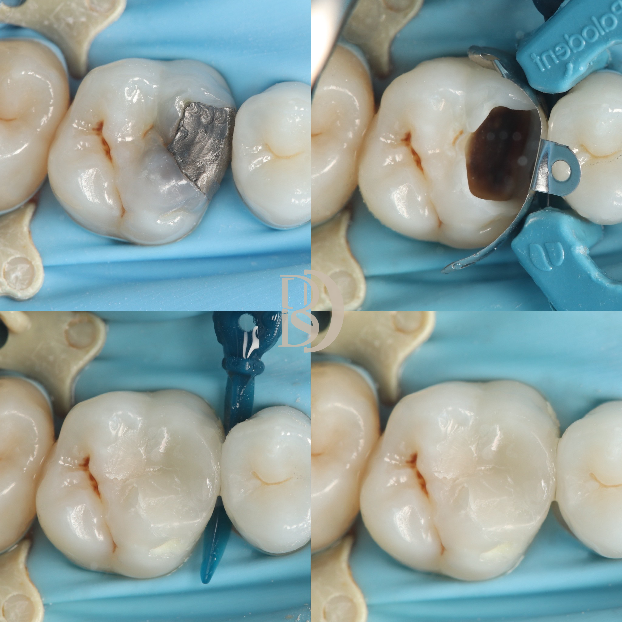 Amalgam replacement.png