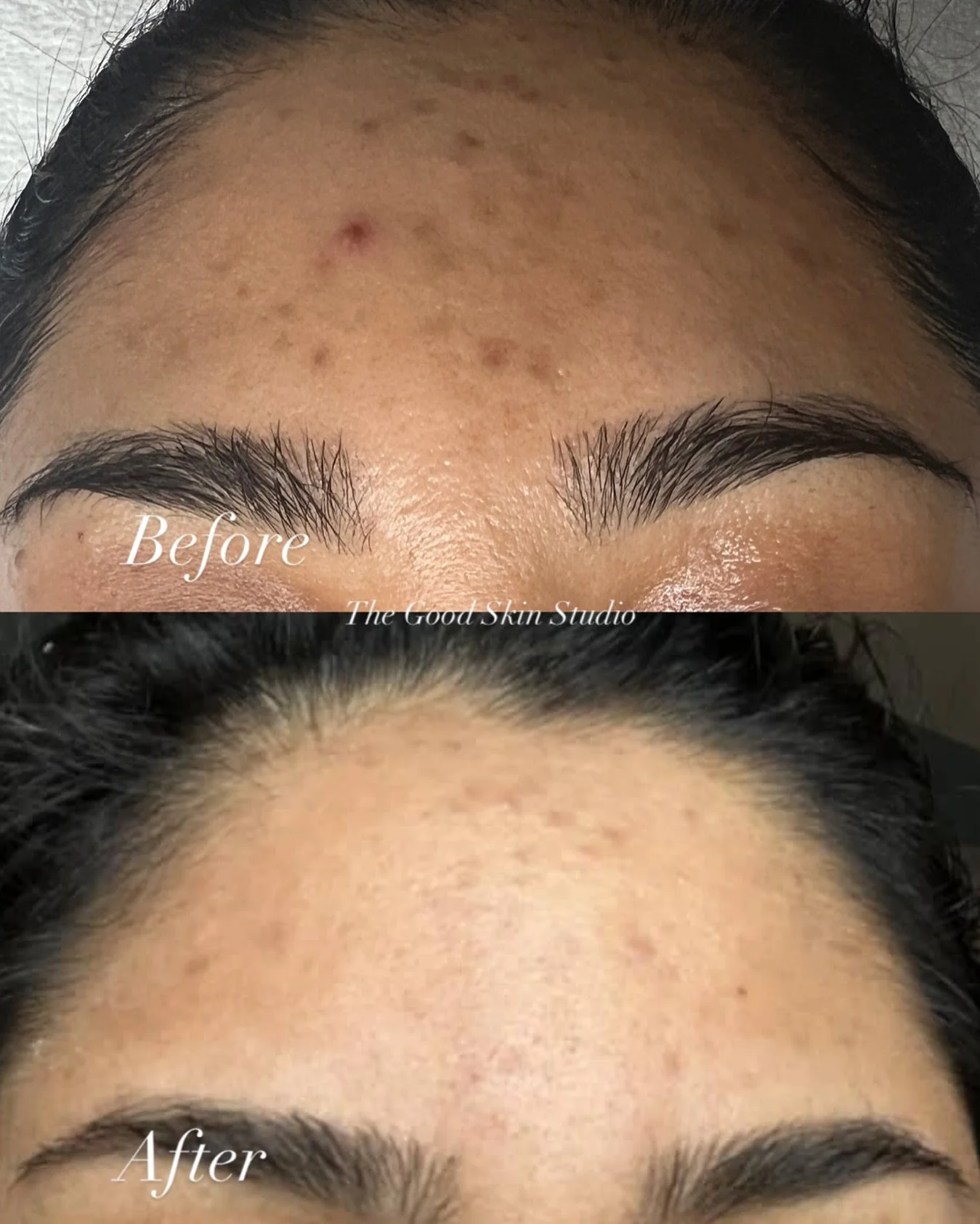 What one session of Zena Algae Peel can do -
	&bull;	Noticeable fading of pigmentation and post-acne marks.
	&bull;	Smoother skin texture.
	&bull;	Less redness and inflammation.
	&bull;	Glowy, calmer skin tone.

No filters. No makeup. Just progress.
