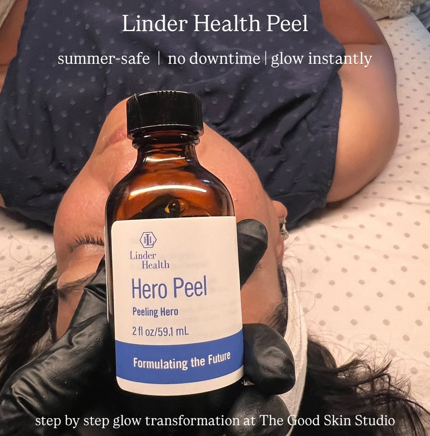 From prep to polish &ndash; here&rsquo;s how yesterday&rsquo;s Linder Health Peel delivered a radiant glow step by step.

Perfect for:
&bull; Dull, tired skin
&bull; Uneven tone &amp; texture
&bull; First signs of aging
&bull; Glow seekers in Brampto