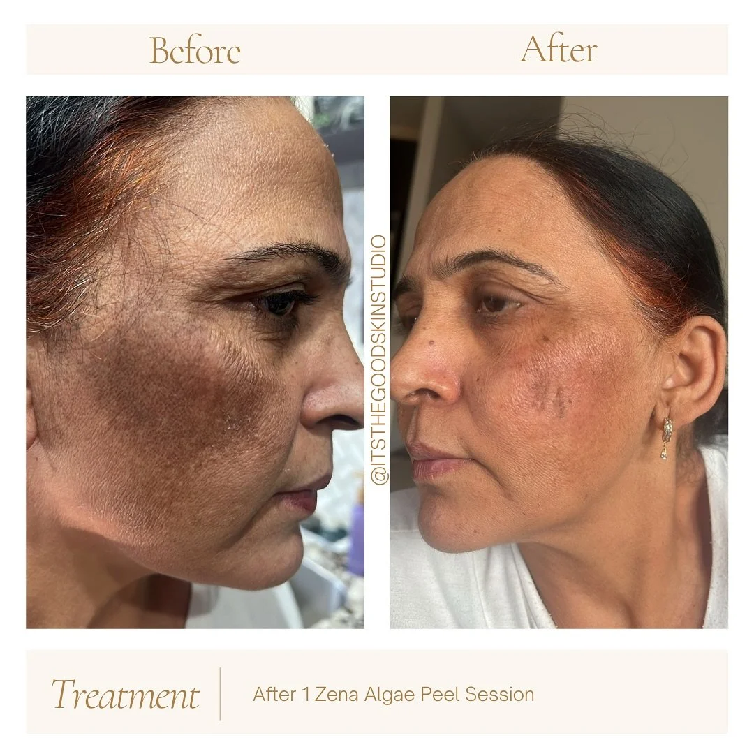 The results are just after just one Zena Algae Peel 🍃

Her skin is already looking smoother, brighter and lighter. These results make me so happy to share ✨

Skincare is a journey but every step counts 💛

📍 The Good Skin Studio, Brampton

#Brampto
