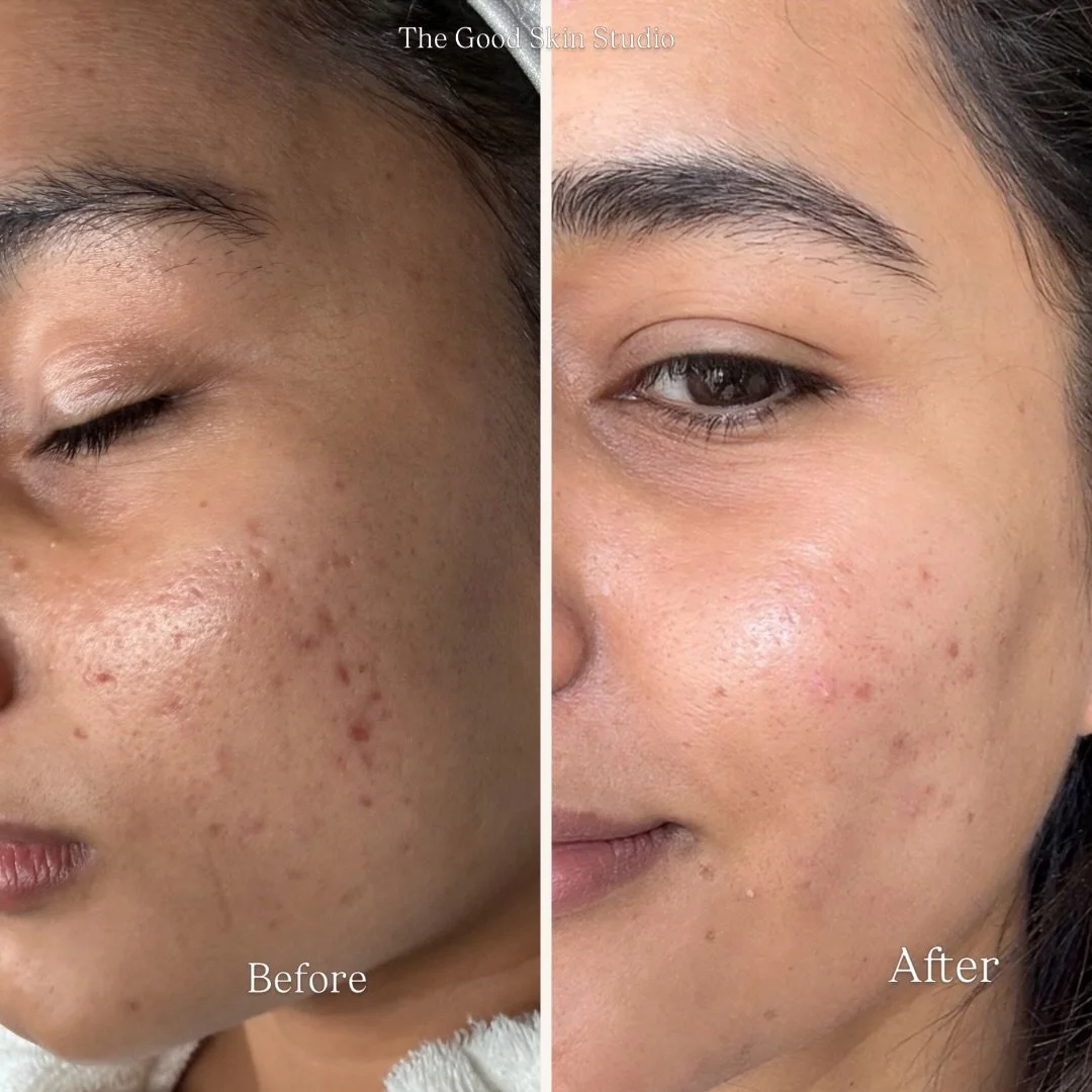 Skin that speaks for itself 🤍 One Zena Algae Peel treatment and the difference is real. less congestion, calmer skin, that glow you&rsquo;ve been chasing.

Book your session at The Good Skin Studio. Link in bio 💚

#SkinTransformation #BeforeAndAfte