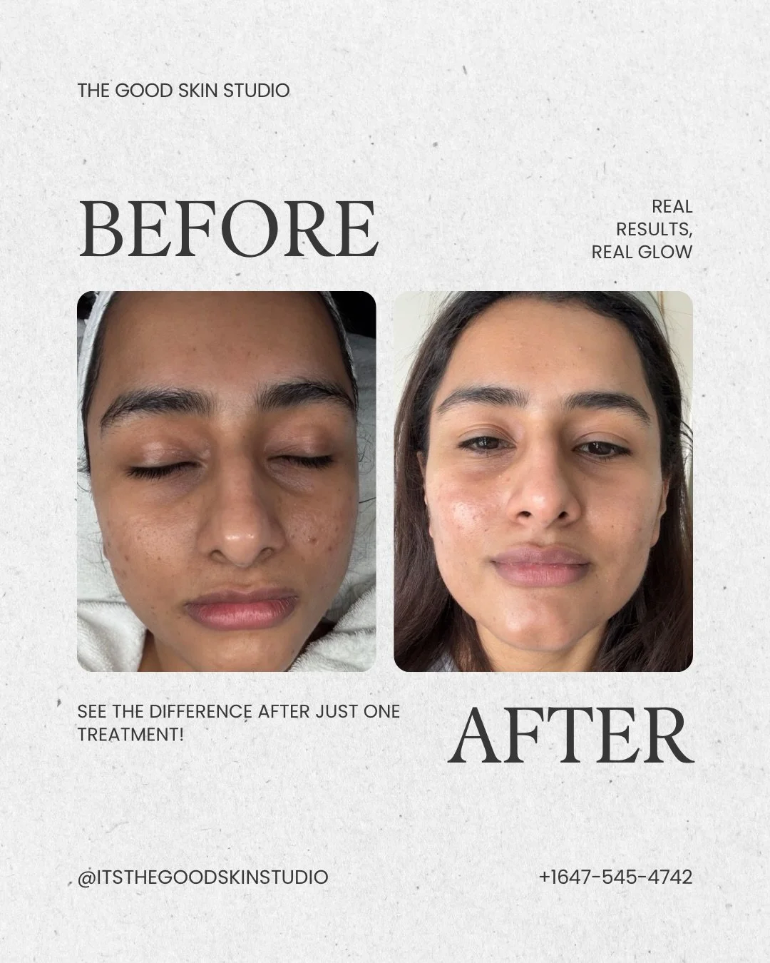 The Zena Algae Peel is the &lsquo;IT GIRL&rsquo; treatment and it&rsquo;s a transformation process.

Days 1&ndash;3: tingling, heat, maybe even purging.
Days 3&ndash;5: tightness + visible peeling.
Days 6&ndash;7: shedding old skin.
Day 8+: fresh, br