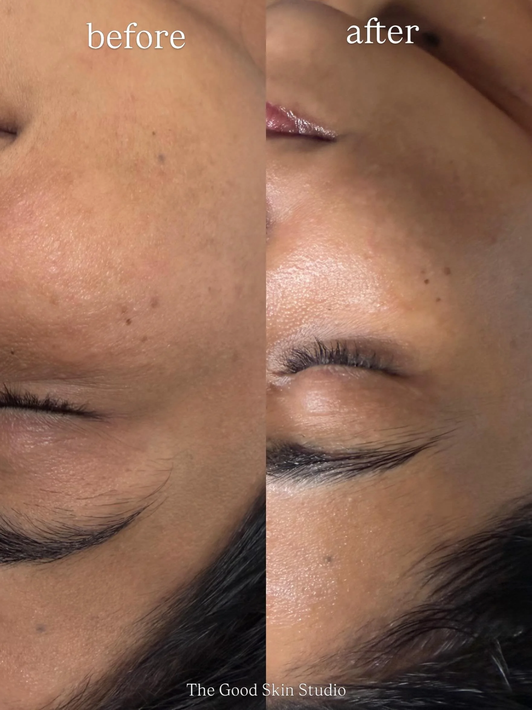 Healthy skin is the first goal. Not every skin transformation is dramatic overnight.

This beautiful client came in with a compromised skin barrier, so instead of chasing aggressive results, we focused on what her skin truly needed first: repair, hyd