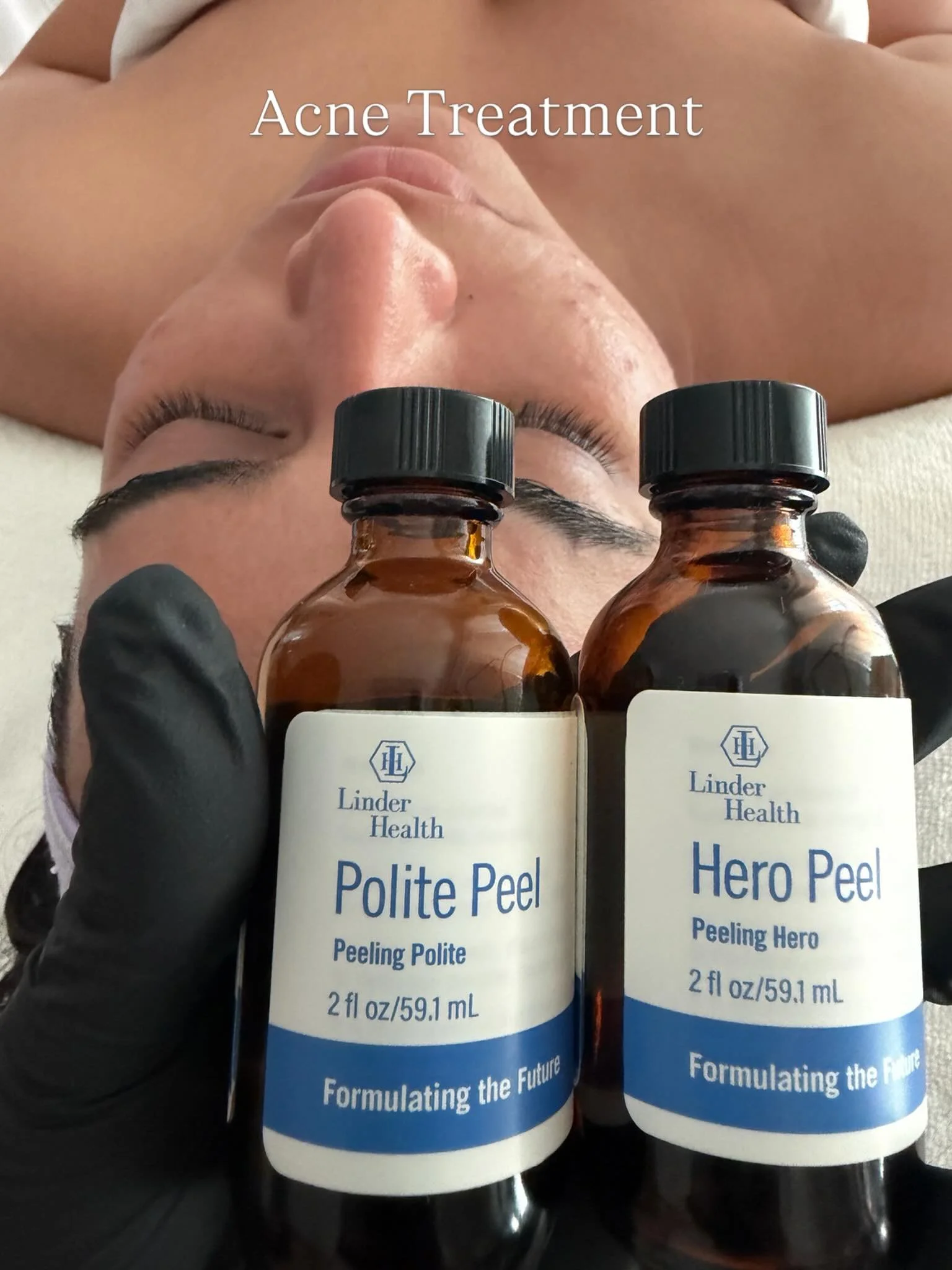 Acne isn&rsquo;t just about drying the skin out. Sometimes the skin needs the right balance of exfoliation + healing. Let&rsquo;s treat acne gently, strategically, and without damaging the skin barrier 🤍
Using corrective peels customized to the skin