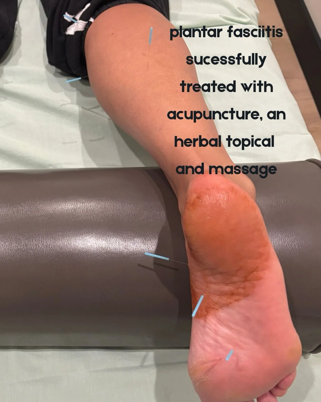 This patient was 90% better after 4 treatments using acupuncture, an herbal topical cream, and massage. If you&rsquo;re in pain from plantar fasciitis, you don&rsquo;t have to be. Make an appointment through my website or contact me at tjfalvai@gmail