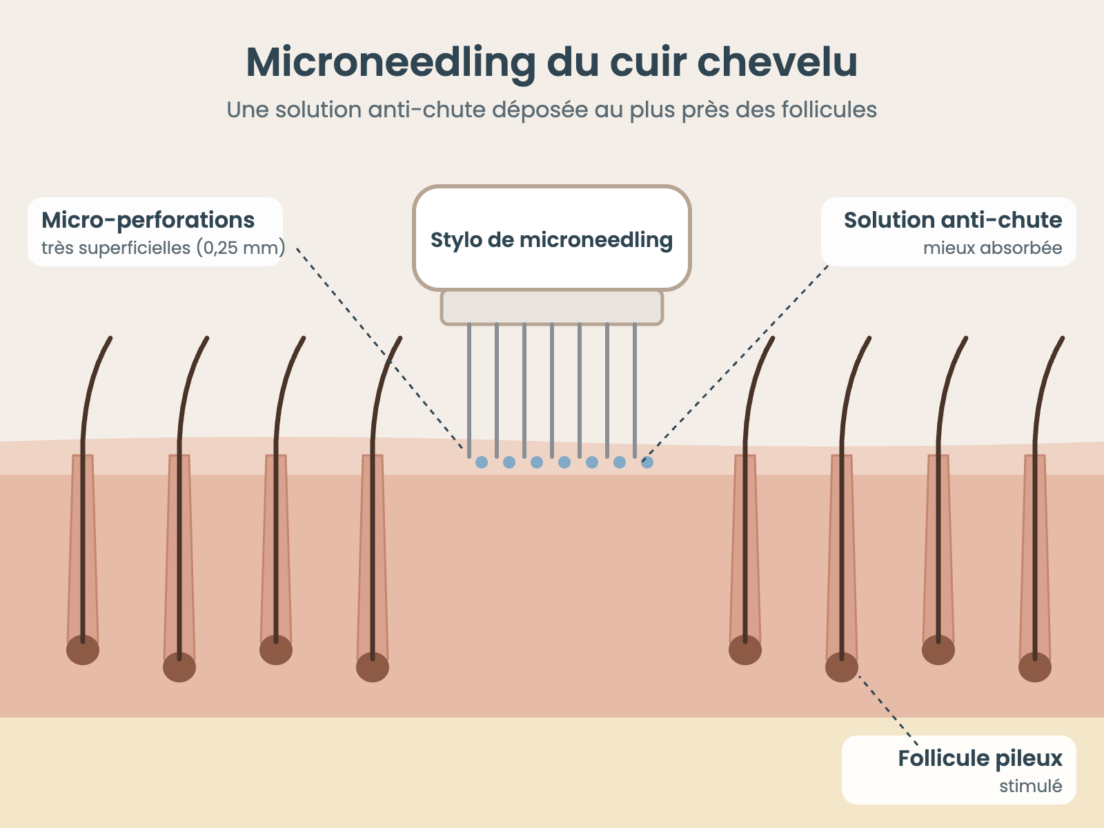 Schéma du microneedling du cuir chevelu : micro-perforations superficielles et solution anti-chute déposée près des follicules pileux