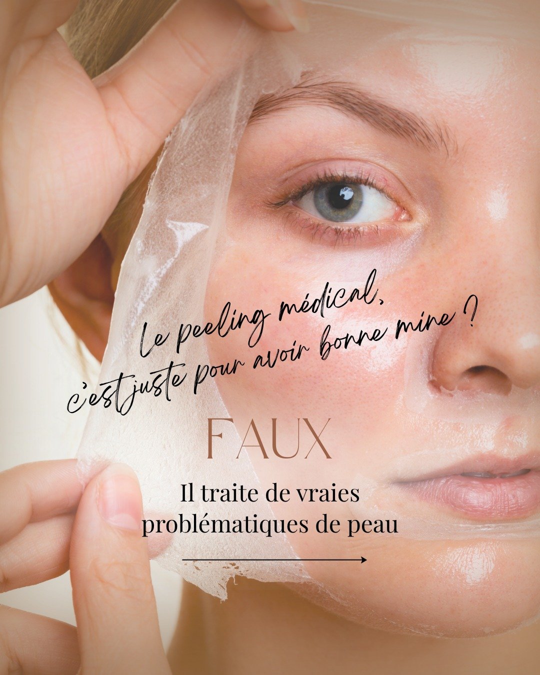 Tu penses que le peeling m&eacute;dical sert uniquement &agrave; &ldquo;avoir bonne mine&rdquo; ? 🤔
👉 En r&eacute;alit&eacute;, c&rsquo;est un v&eacute;ritable traitement de la peau.

Acn&eacute;, taches pigmentaires, teint terne, ridules, cicatric