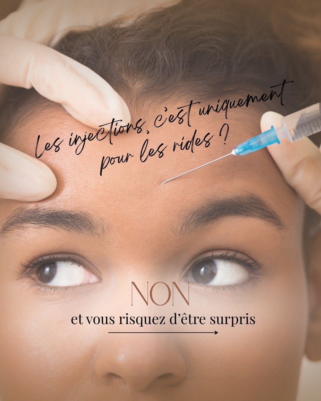 &ldquo;Les injections, c&rsquo;est uniquement pour les rides ? 🤔&rdquo;

👉 Non. Et c&rsquo;est souvent l&agrave; que tout commence.

Aujourd&rsquo;hui, les injectables permettent bien plus que de lisser :
💧 hydrater en profondeur
✨ am&eacute;liore