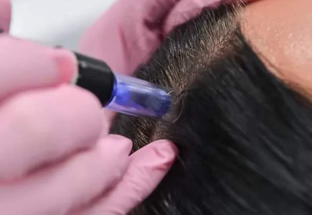 Une personne effectue un microneedling sur le cuir chevelu.