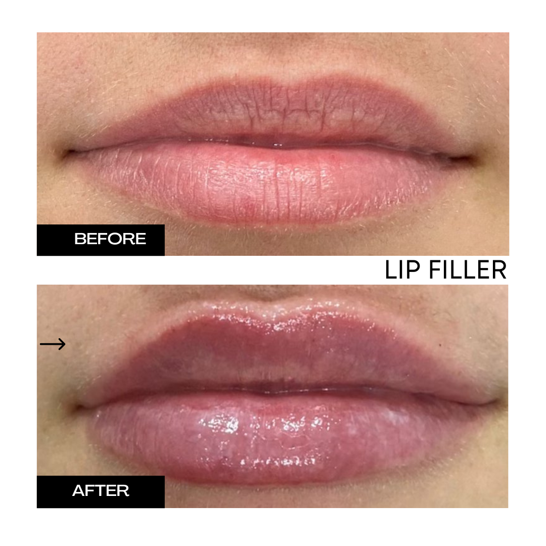 Lip Filler 1.png