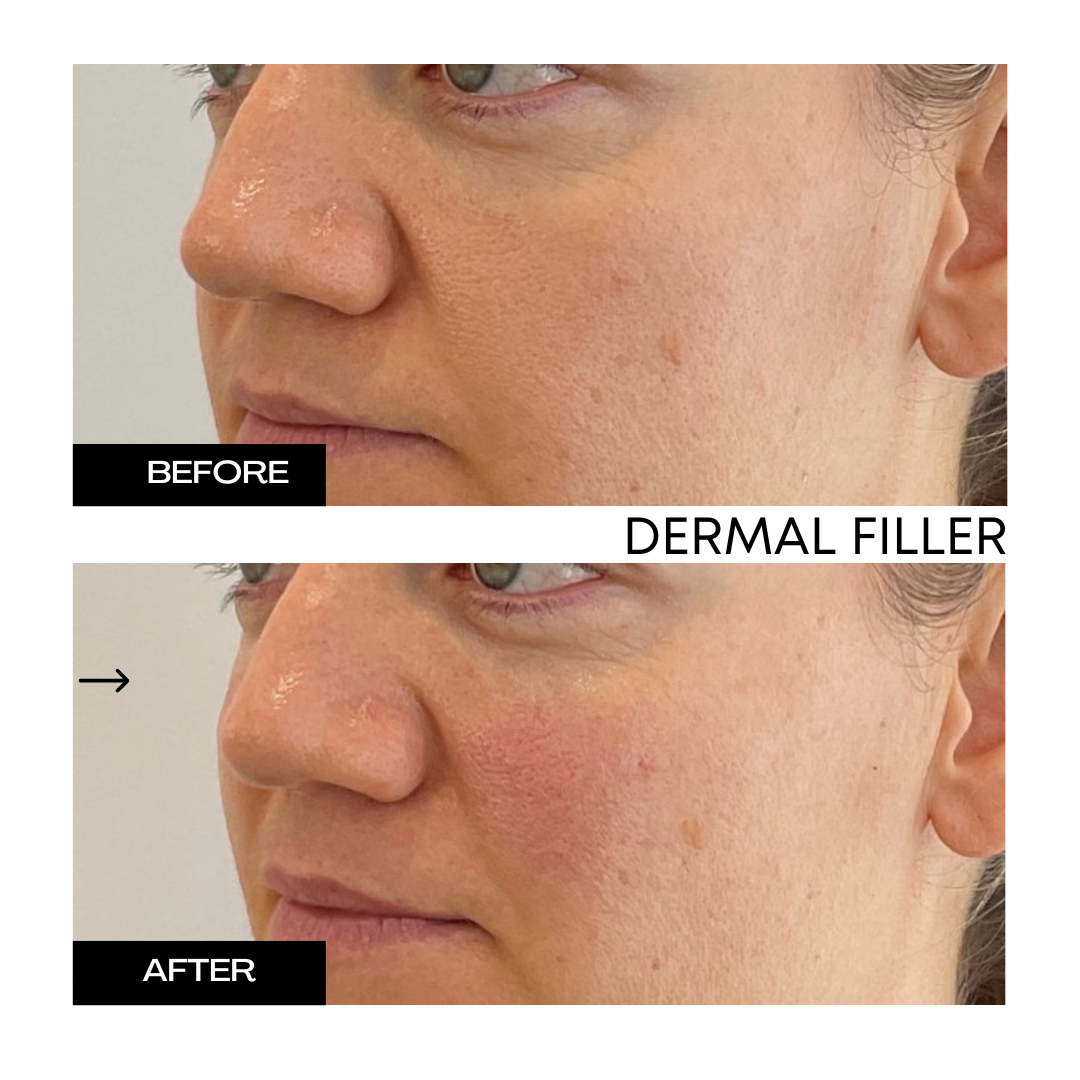 Dermal Filler 1.png