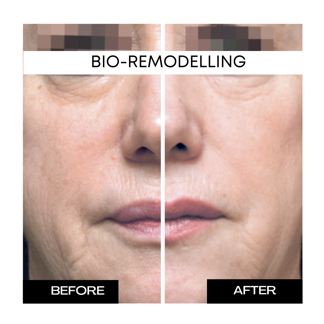 Bio-Remodelling 1.png