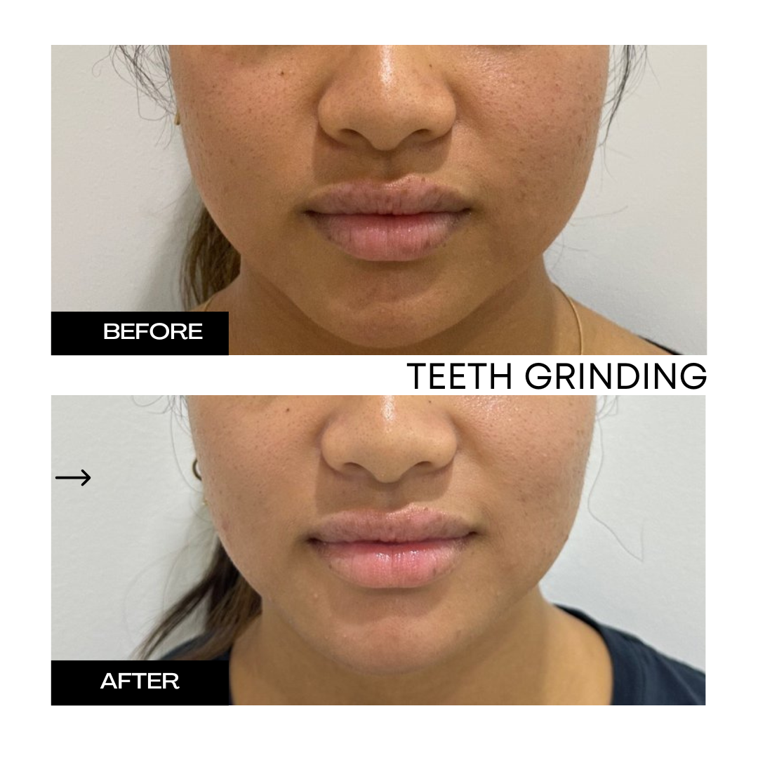 Teeth Grinding 1.png