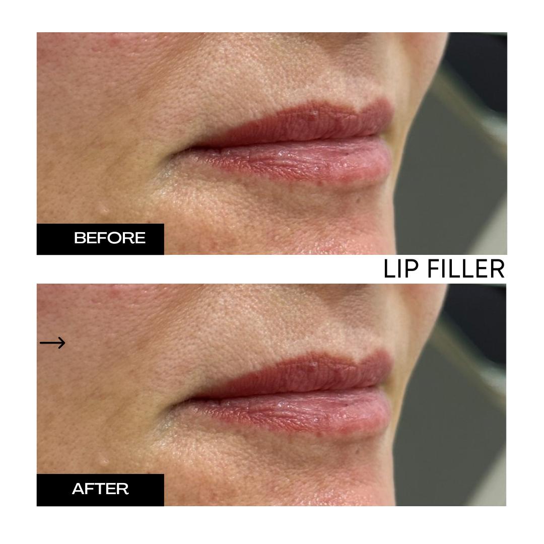 Lip Filler 2.png