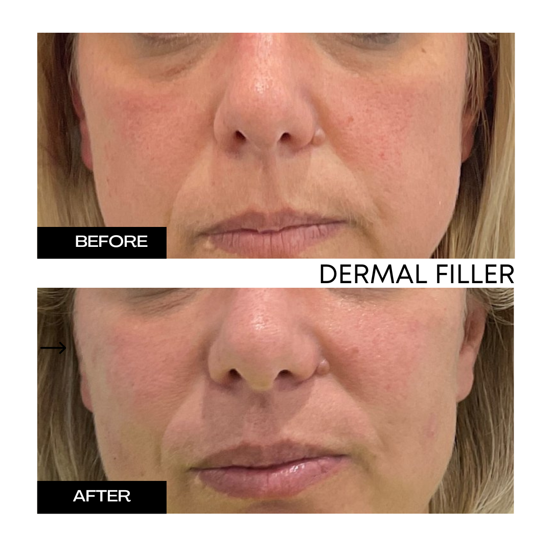 Dermal Filler 2.png