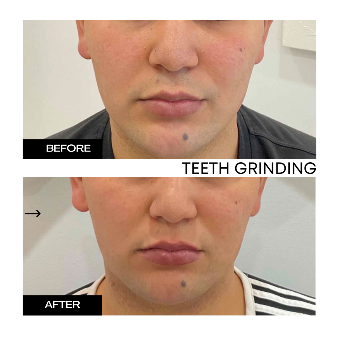 Teeth Grinding 1 (2).png