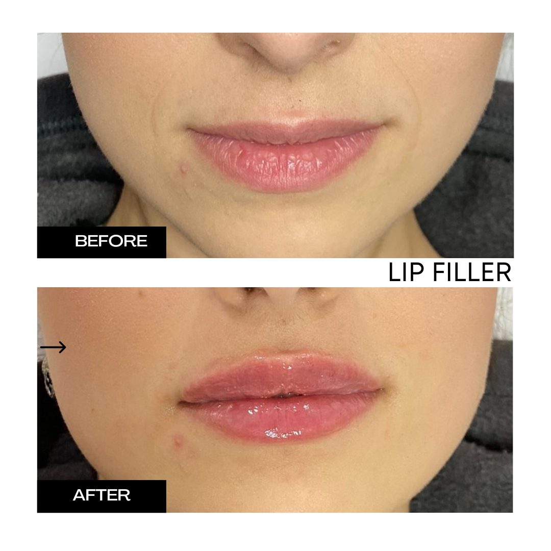 Lip Filler 3.png
