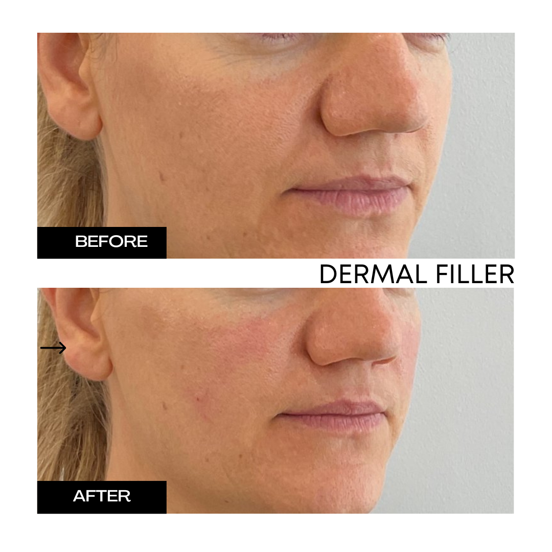 Dermal Filler 3.png