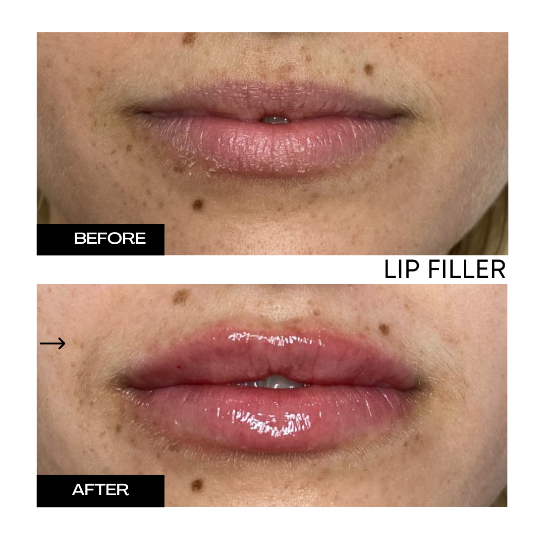 Lip Filler 4.png
