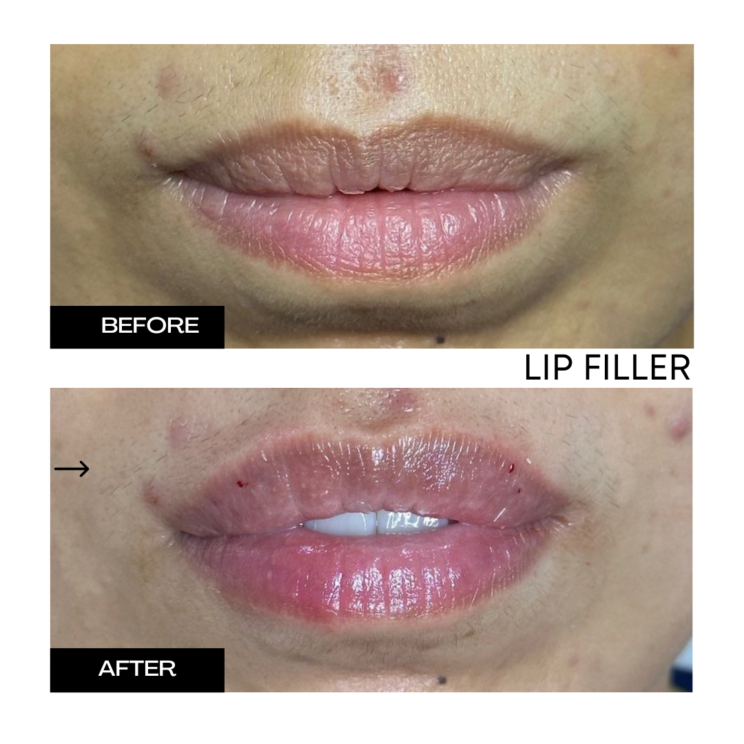 Lip Filler 5.png